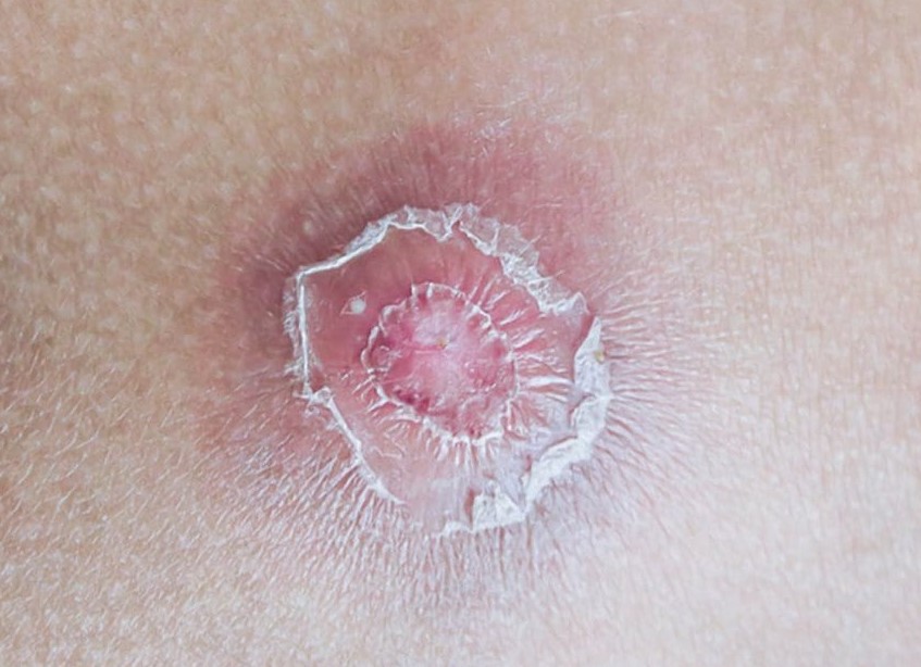 boil infection